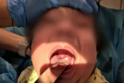 Lékaři v Ostravě museli hospitalizovat 3 lidi pro život ohrožující záškrt