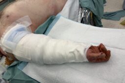 V anenské nemocnici proběhl unikátní výkon. Doktoři přišili amputovanou ruku