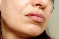 Nepříjemné opary. Léčba závisí na jejich fázi. Častým spouštěčem bývá stres