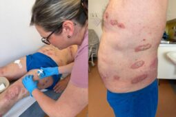 Novinka v třebíčské nemocnici. Kožní oddělení nabízí pacientům biologickou terapii
